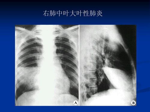 做完核磁后注意事项