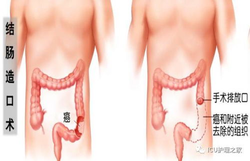 肠造瘘患者术后注意事项