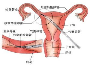 结扎复通术后注意事项