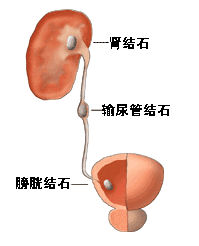 尿路结石术后注意事项有哪些,尿路结石插管术后注意事项,尿路结石微创手术后注意事项