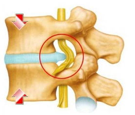 腰椎盘凸出注意事项