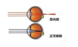 散光配眼镜的注意事项