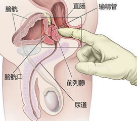 前列腺结石注意事项