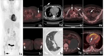 做完,注意事项,pet,ct