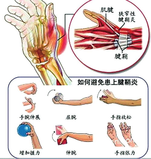 大拇指腱鞘炎注意事项