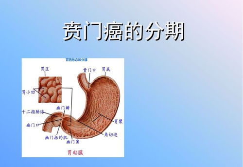 贲门癌手术体位注意事项,贲门癌的饮食注意事项,贲门癌术前注意事项