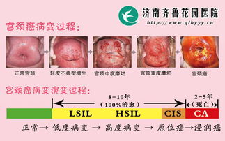 tct和hpv检查后注意事项,做完tct检查后注意事项,tct检查前注意事项