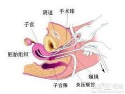 引产,注意事项,有哪些