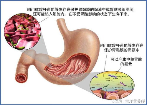 吃治疗幽门杆菌的药注意事项