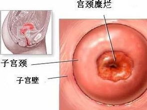 宫颈糜烂日常注意事项,宫颈糜烂注意事项有哪些,微波治疗宫颈糜烂后注意事项