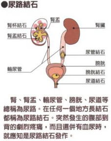 尿路结石术后注意事项