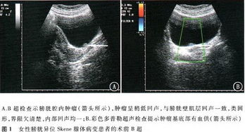 女性查体b超注意事项