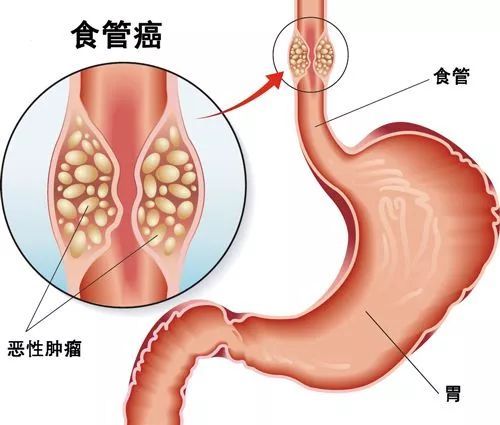 食道癌,注意事项,插管