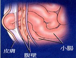 有什么,疝气,手术后,注意事项