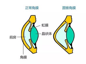 圆锥角膜术后注意事项,圆锥角膜平时注意事项,圆锥角膜配镜注意事项