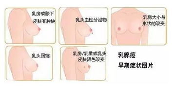 乳头乳晕漂色注意事项