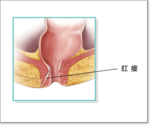 艾滋病可以做肛瘘手术吗,艾滋病肛瘘去哪里手术,艾滋病肛瘘手术多久恢复