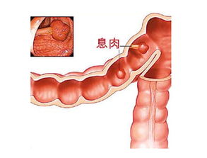直肠,息肉,注意事项,饮食