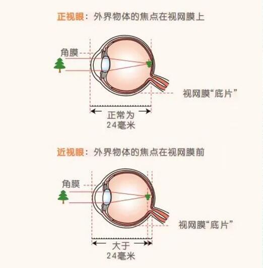 孩子散瞳后注意事项