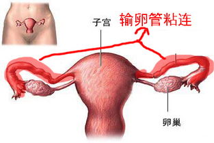 输卵管粘连术后注意事项