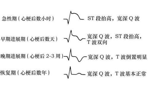 心电图,要注意,事项,检查