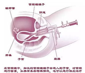 试管,注意事项,宫腔镜