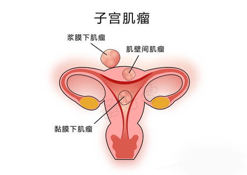 粘膜下子宫肌瘤宫腔镜手术后注意事项