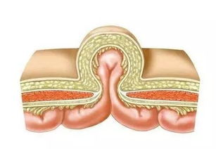 小孩开疝气手术后注意事项