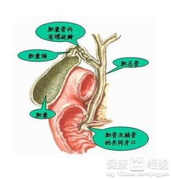 胆结石,注意事项,发生