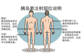 写出胰岛素注射的注意事项