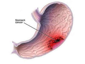 胃部,出血,注意事项