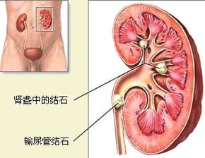 肾结石注意事项及饮食禁忌,肾结石日常生活注意事项,肾结石术后注意事项