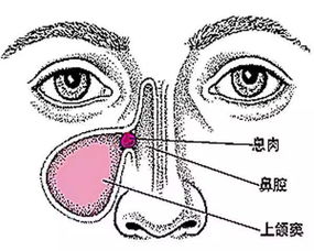 单侧鼻息肉注意事项