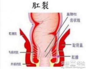 流血,注意事项,肛裂