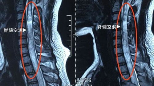 造影,脊髓,术后,注意事项