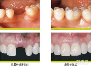 补牙,拔牙,注意事项