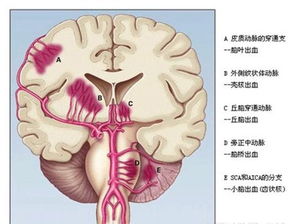 脑出血患者鼻饲注意事项,脑出血昏迷鼻饲注意事项,鼻饲的护理和注意事项