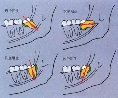 拔了阻生牙后注意事项