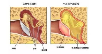 患急性中耳炎注意事项