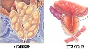 前列腺插管治疗后注意事项