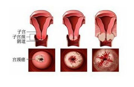 子宫切除术后注意事项,瘢痕子宫怀孕注意事项,子宫息肉术后注意事项