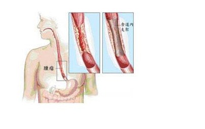 食道癌,手术后,注意事项