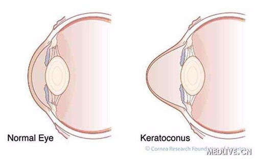 角膜,圆锥,注意事项