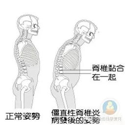 置换关节术后注意事项