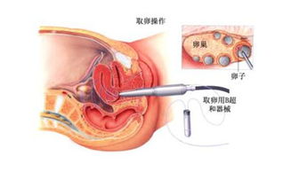 试管取卵前1天注意事项