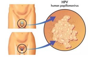 尖锐湿疣,北京,注意事项,军都诊