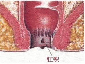 肛裂流血注意事项