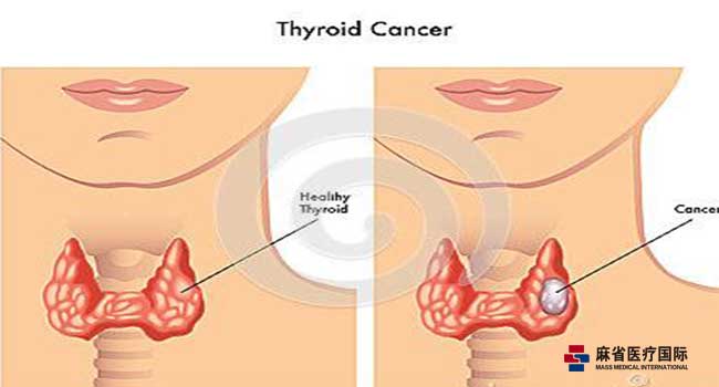 甲状腺,肿瘤,手术后,注意事项