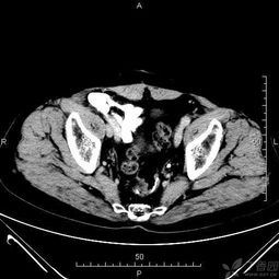 盆腔ct定位注意事项