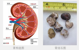 肾结石注意事项及饮食